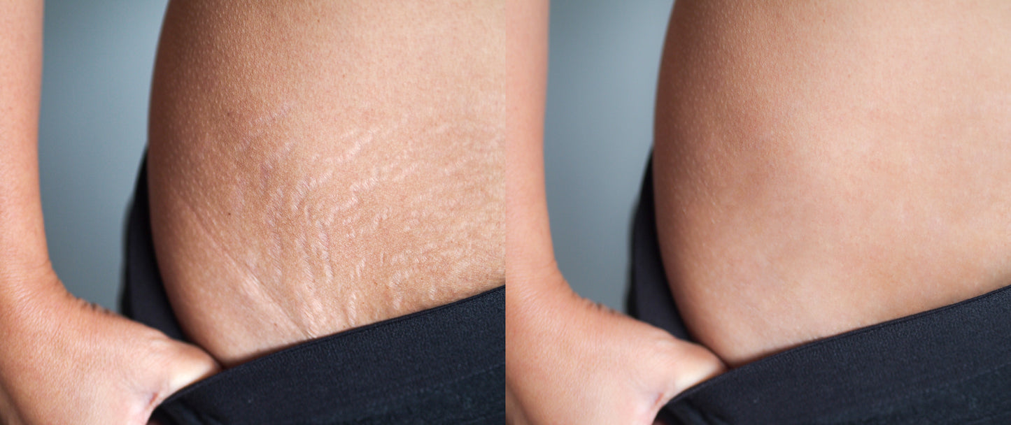 Stretch Mark & Scar Cream